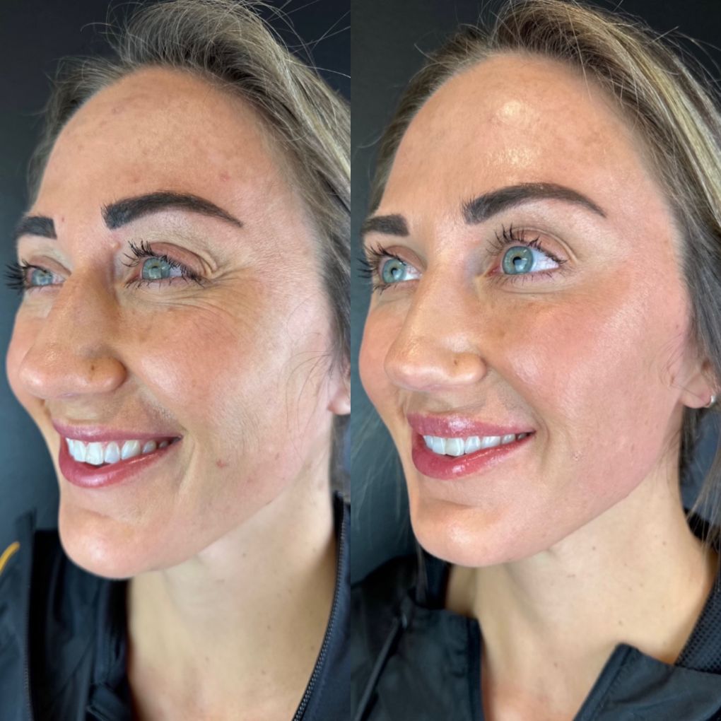 patient before and after Wrinkle Relaxer procedure