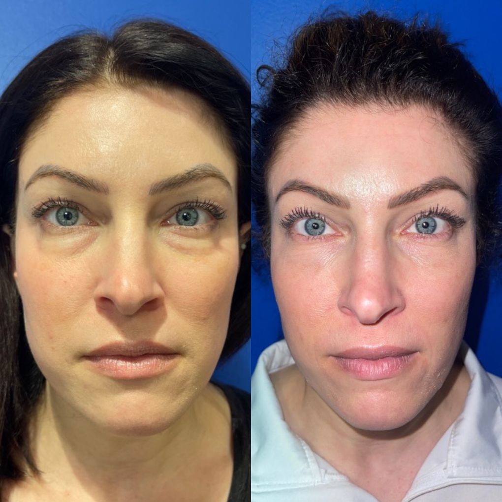 patient before and after non-surgical procedure
