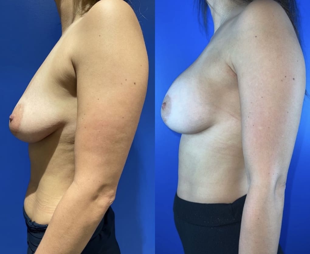 patient before and after breast augmentation with lift procedure