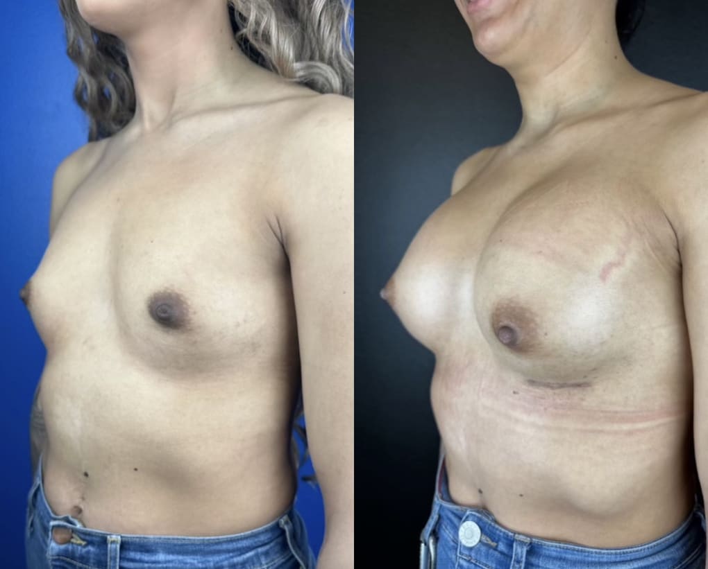 patient before and after breast augmentation procedure
