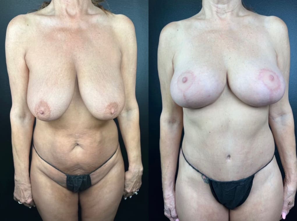 patient before and after Breast Lift and Tummy Tuck procedures