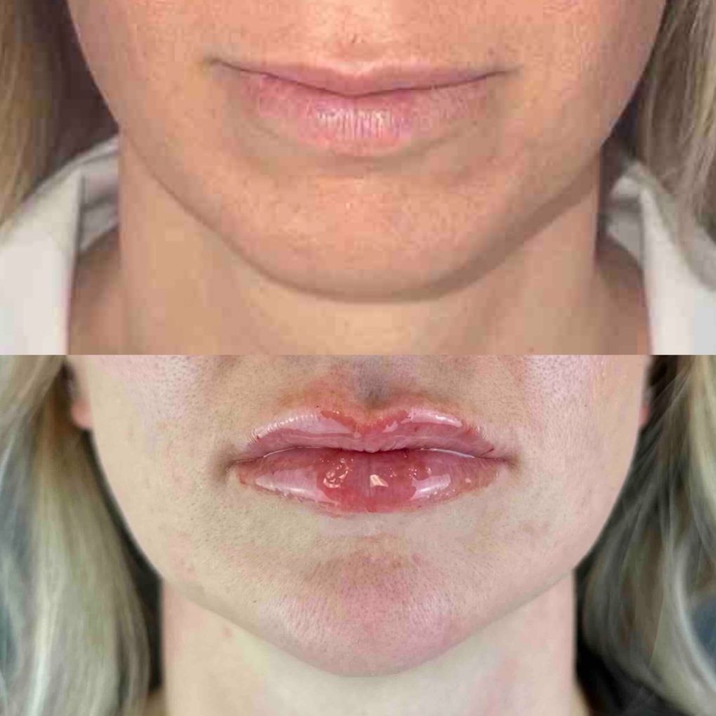 patient before and after Chin Filler procedure