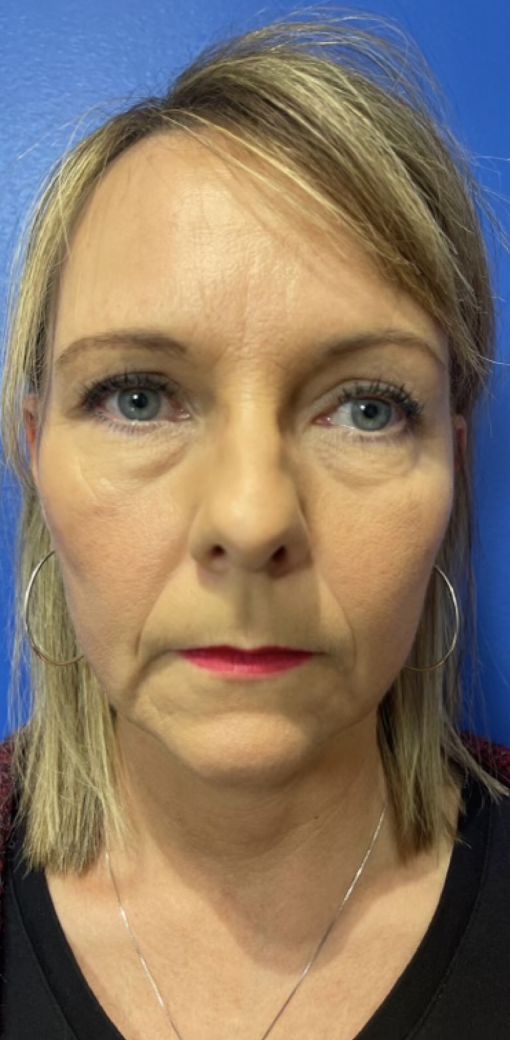 patient before eyelid surgery