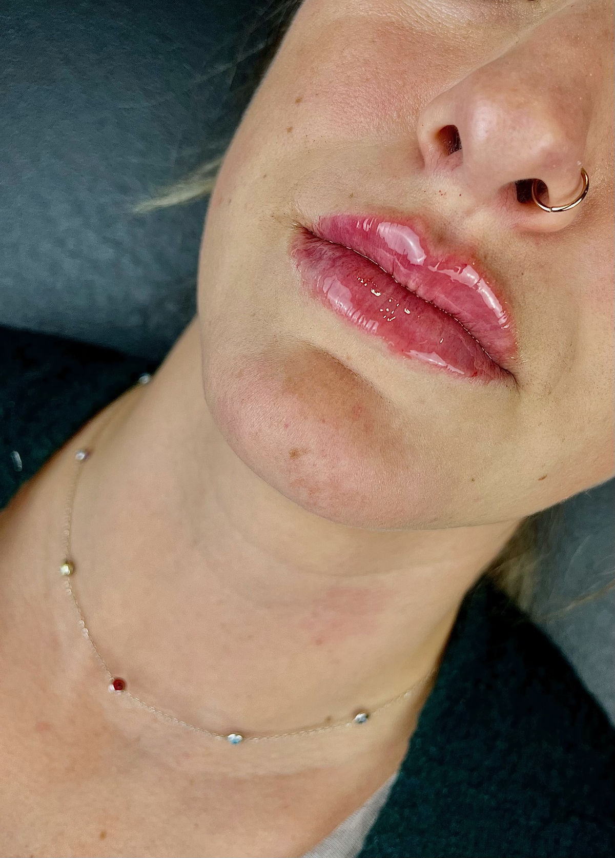 patient after lip filler procedure