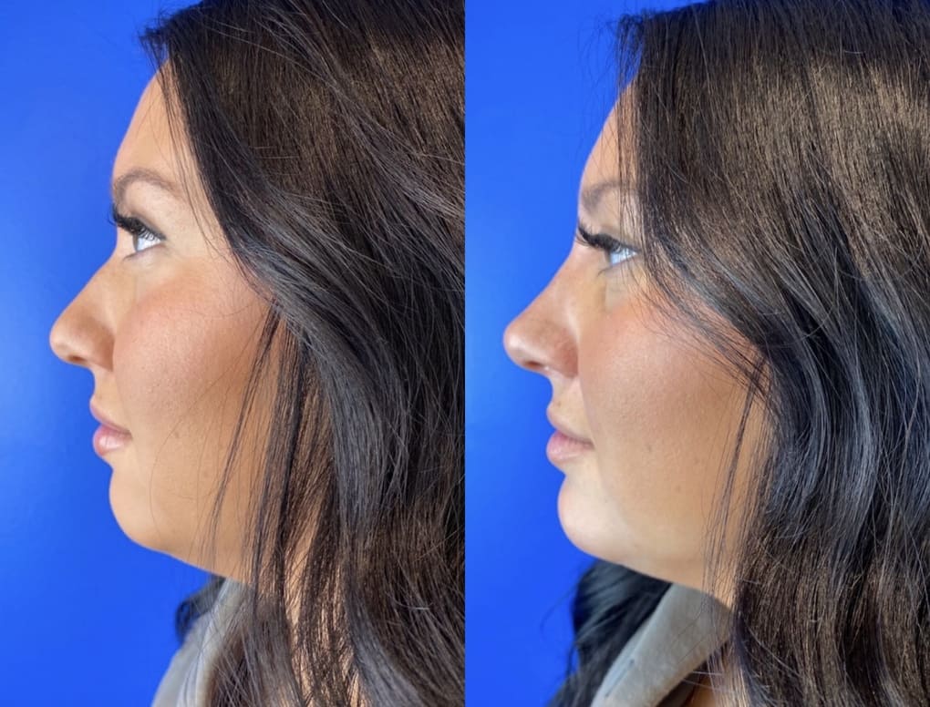 patient before and after liquid rhinoplasty procedure