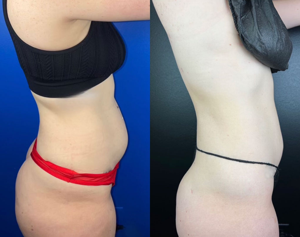 before and after liposuction procedure