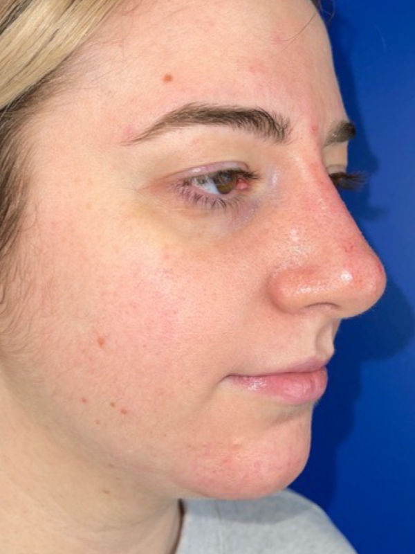 Woman's face after Liquid Rhinoplasty treatment
