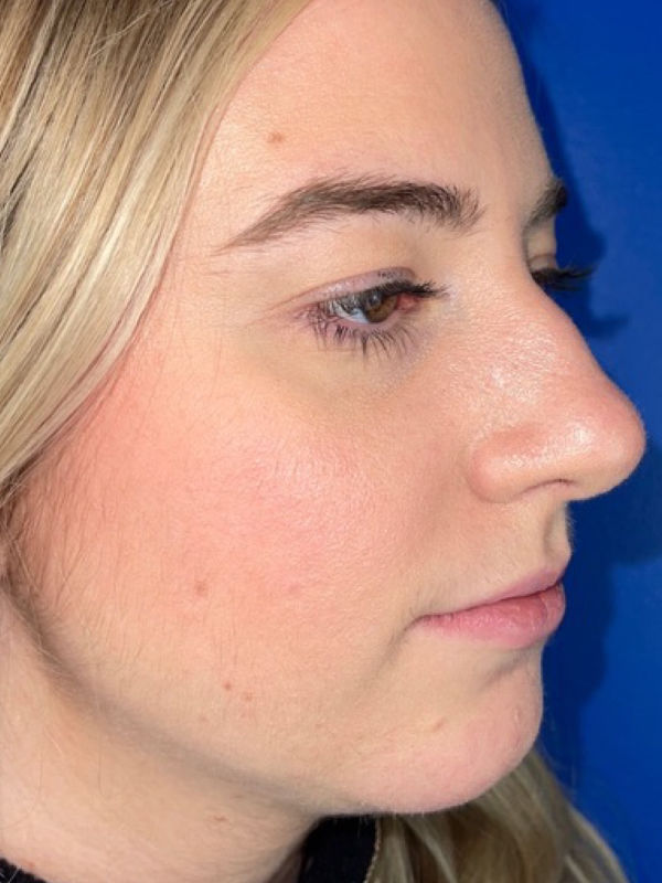 Woman's face before Liquid Rhinoplasty treatment