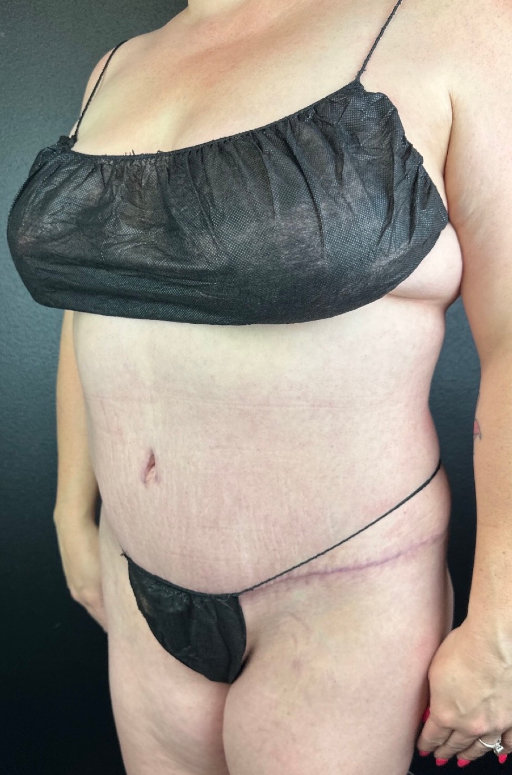 A person wearing a black bandeau top and black underwear, standing side-profile with visible abdominal scars.