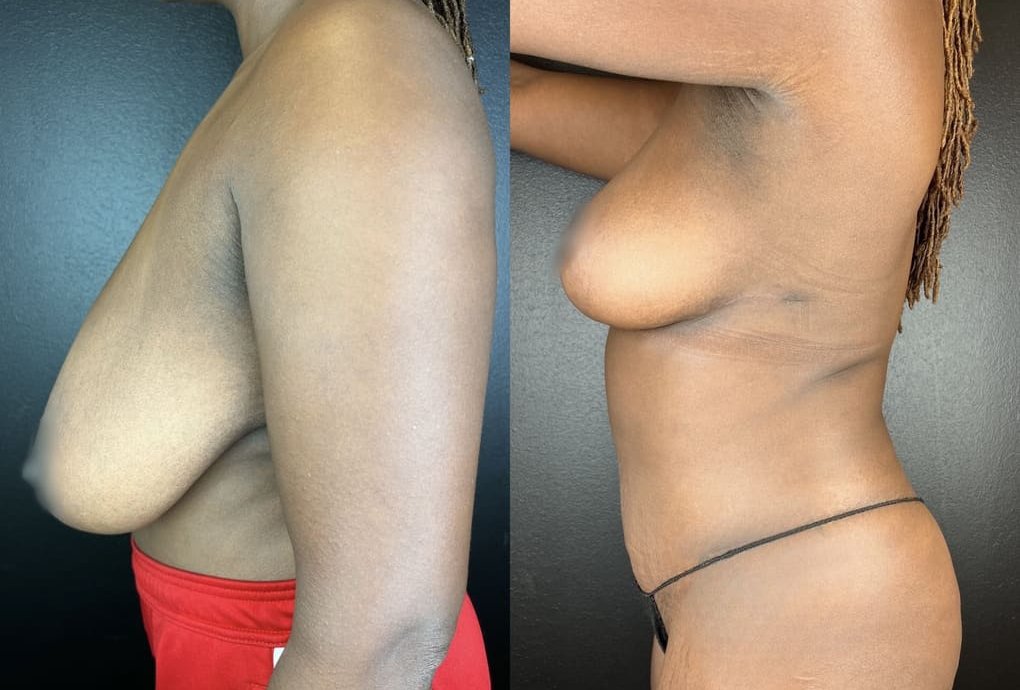 patient before and after breast lift procedure