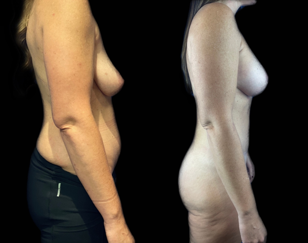 before and after lipo and breast augmentation