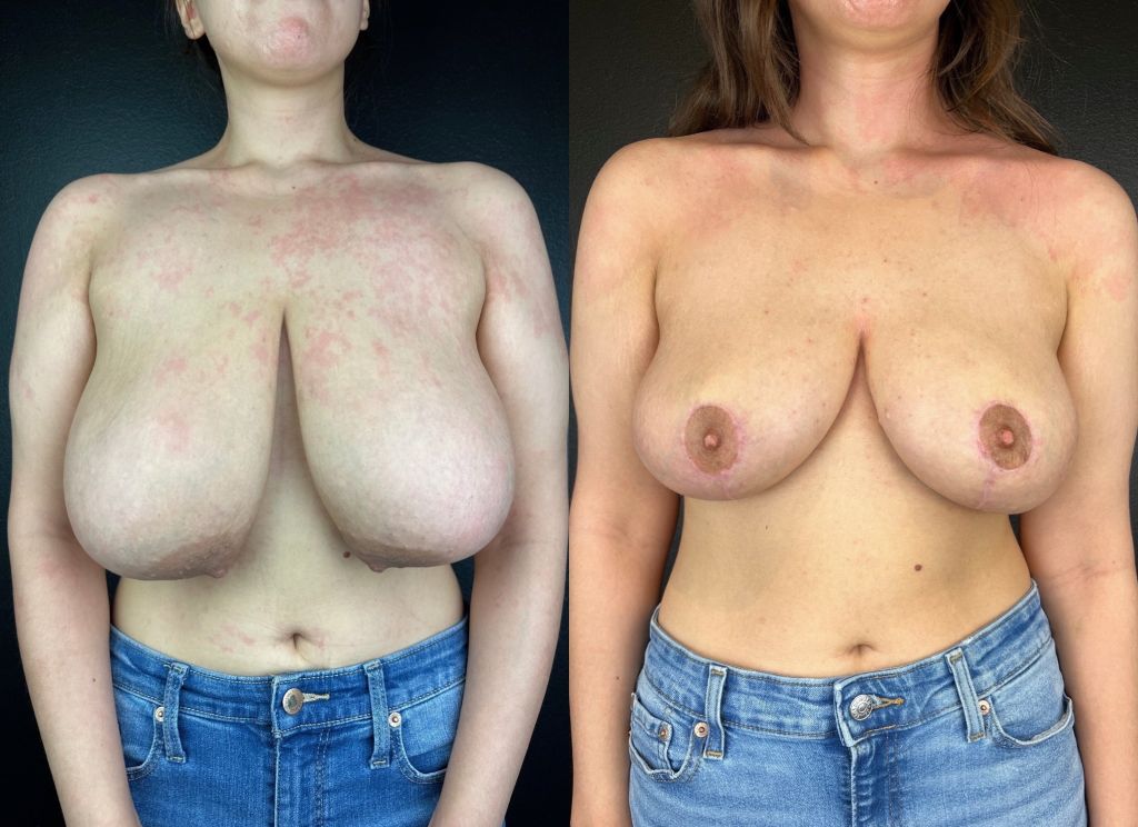 patient before and after breast reduction procedure