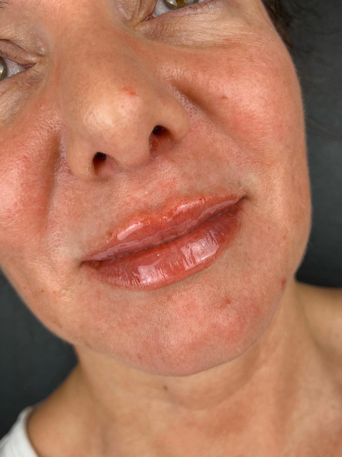 patient after lip filler treatment