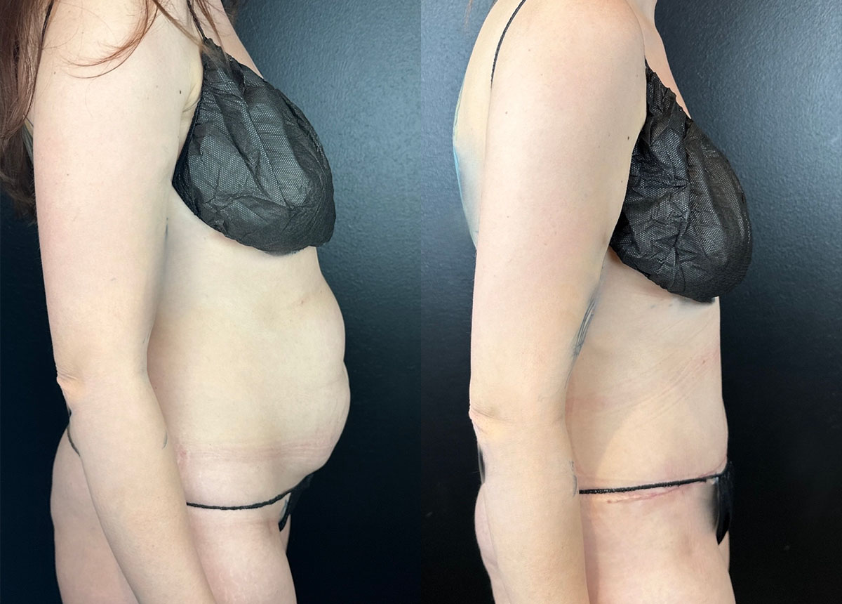 patient before and after tummy tuck procedure