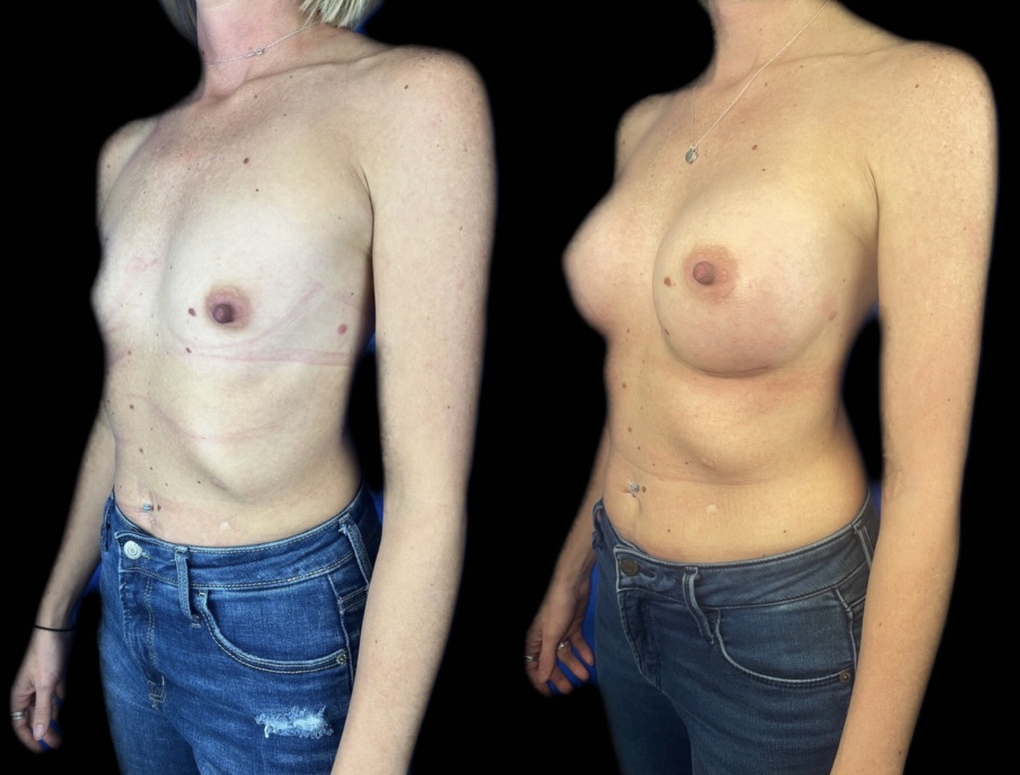 patient before and after breast augmentation procedure