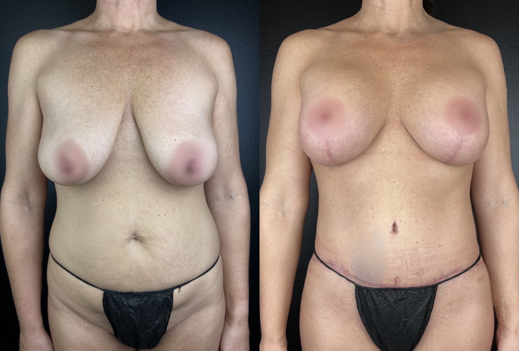 before and after breast lift and tummy tuck procedure