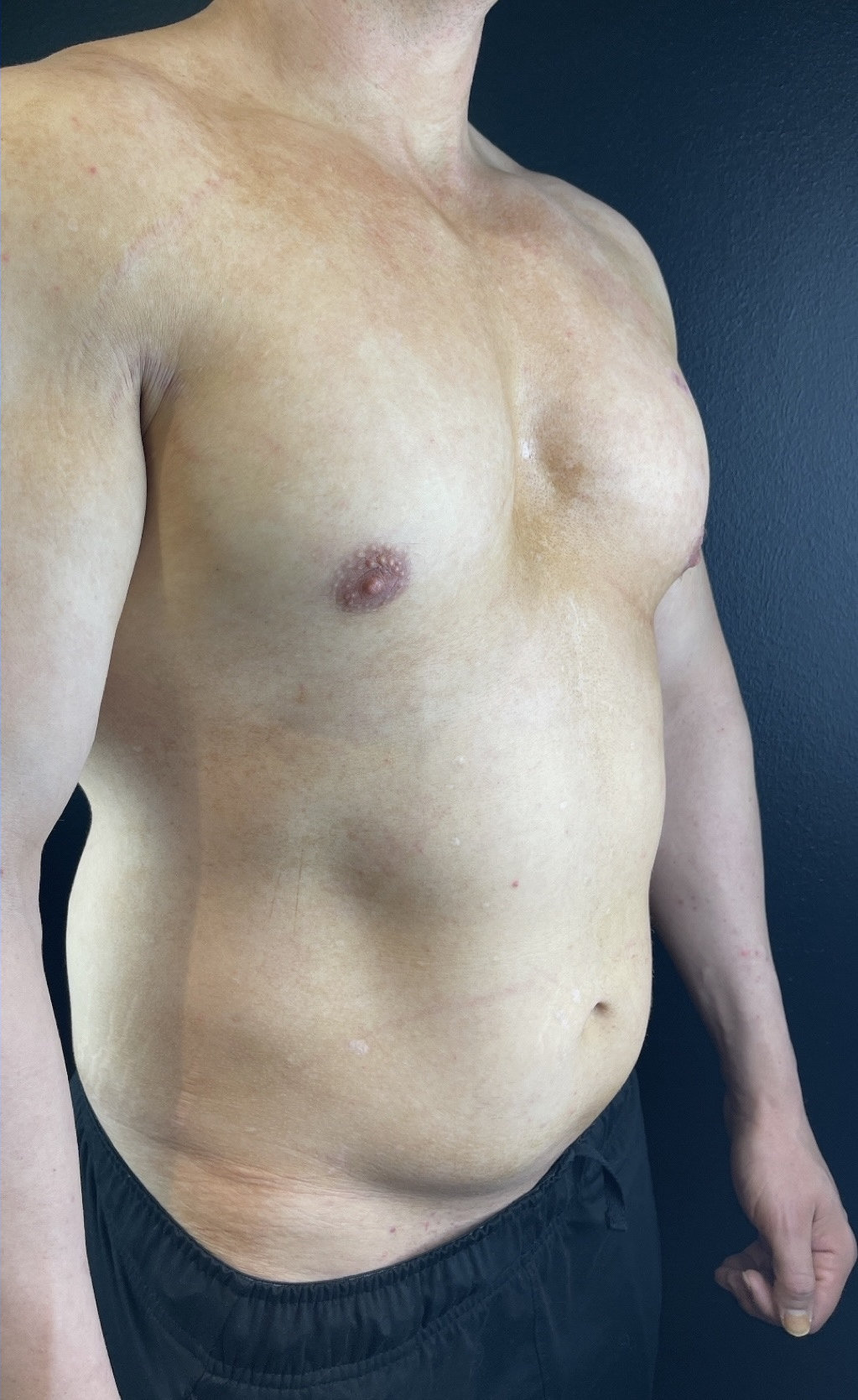 A shirtless man with a pale complexion stands against a dark background, showing his torso and one arm, visible signs of skin blemishes.