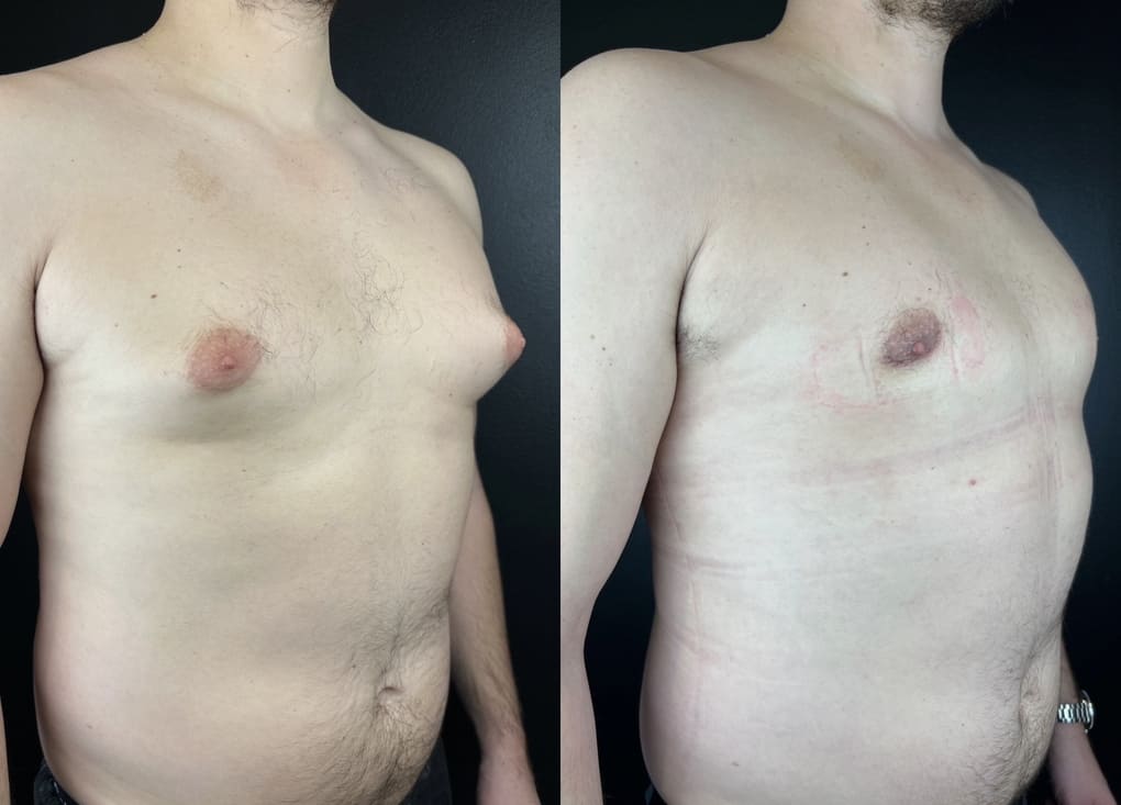 patient before and after gynecomastia procedure