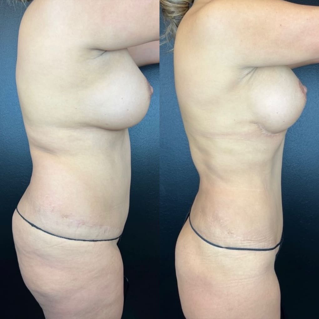 patient before and after breast augmentation and liposuction procedure