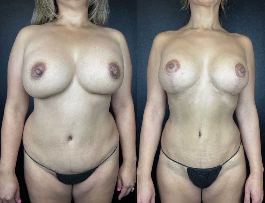 patient before and after breast augmentation and liposuction procedure