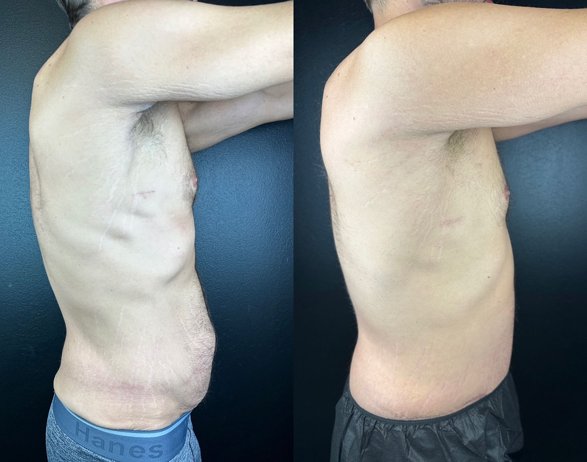 Side-by-side comparison of a person's torso before and after a medical procedure. The left image shows a protruding abdomen; the right image shows a flatter abdomen.