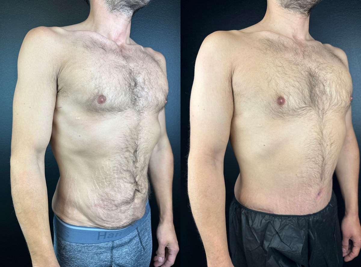 Side-by-side images of a shirtless man showing a before (left) and after (right) comparison of his upper body.